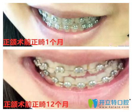 正頜術前正畸牙齒變化圖