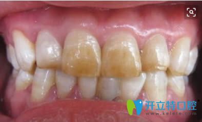 中度氟斑牙圖片 中度氟斑牙圖片