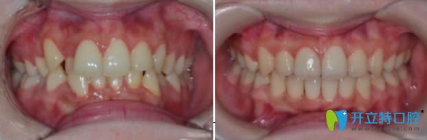 麗江錦美口腔成人牙齒擁擠不齊矯正案例效果