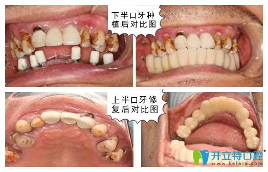 深圳諾德齒科水激光種牙后對比圖