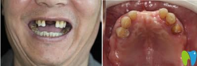 種植牙真實(shí)案例見(jiàn)證重慶齊美口腔到底好不好？