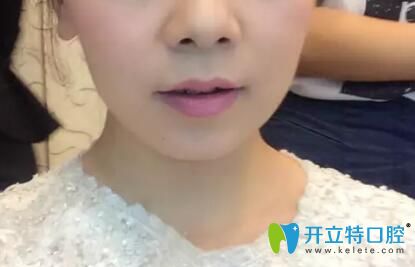 掩飾性正畸后正頜成功經驗分享