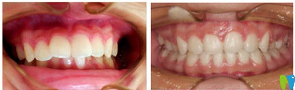 正畸安氏分類詳解及對(duì)應(yīng)的矯正方法