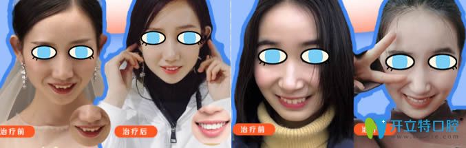 成人虎牙矯正和齙牙矯正前后對(duì)比效果圖