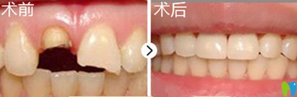 牙齒美容修復(fù)前后對(duì)比圖