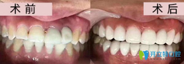 牙齒美學修復效果圖