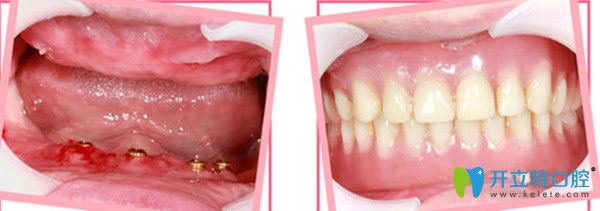 全口種植牙前后對比照