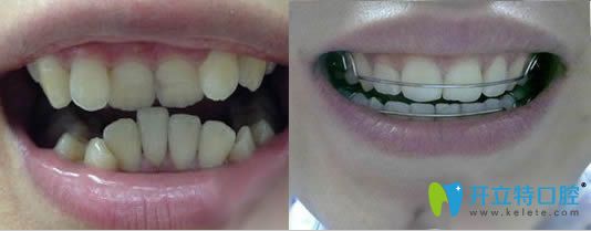 牙齒矯正后會(huì)容易早掉嗎