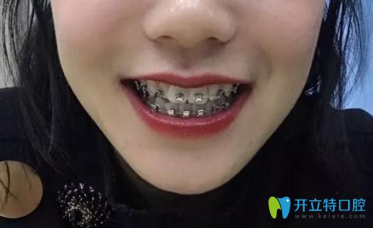 邯鄲連保強口腔戴金屬牙套一個星期