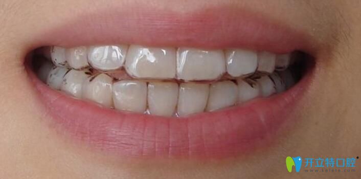 博思美隱形矯正的適應癥狀