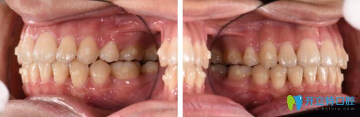 博思美隱形矯正效果好不好？來看看小姐姐的案例