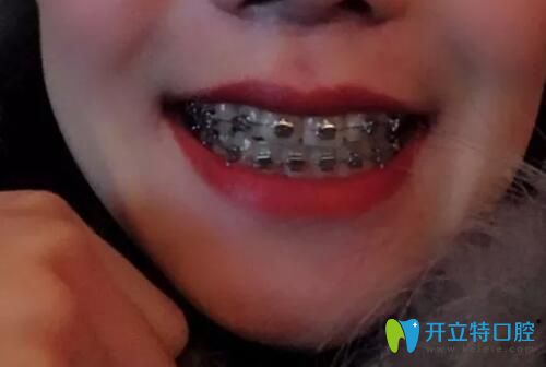連保強口腔牙齒矯正1個月