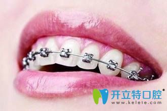 牙醫(yī)否定矯正牙齒老了會容易掉牙，原因在此