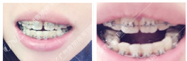 牙齒稀疏不齊在廣州壹加壹矯正四個月，變化大嗎