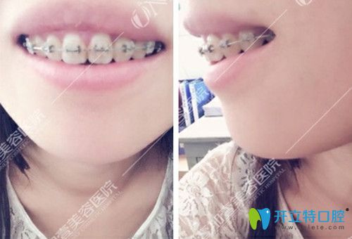 牙齒稀疏的整牙3個月的效果圖