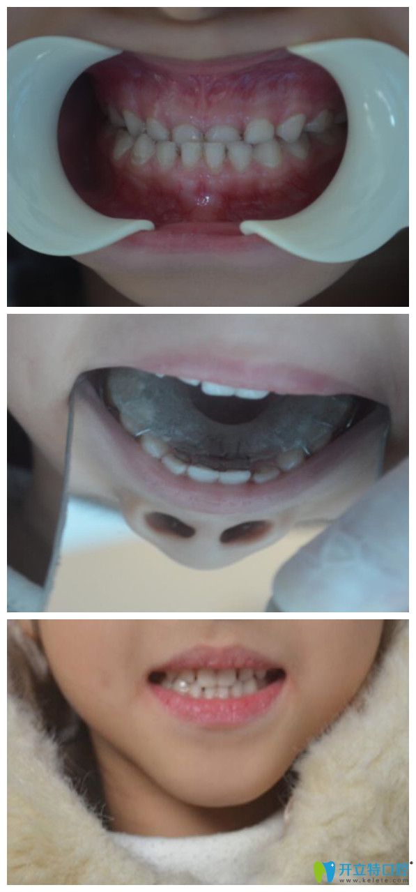 牙齒活動矯正器有效果嗎