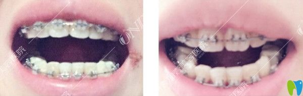 牙齒矯正第二個月變化圖