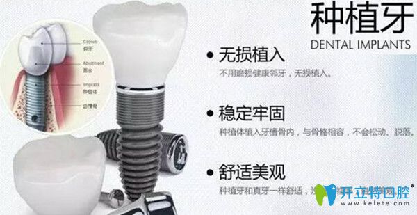 德國(guó)Camlog種植系統(tǒng)優(yōu)勢(shì)