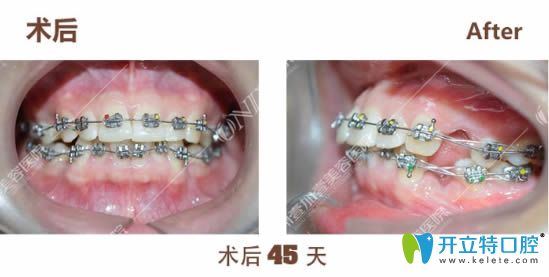 戴金屬托槽矯正器拔牙后45天的樣子