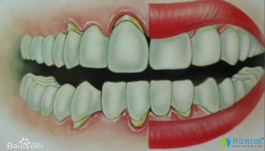牙槽骨萎縮假牙掛不住，請(qǐng)問(wèn)牙槽骨萎縮還能恢復(fù)嗎？
