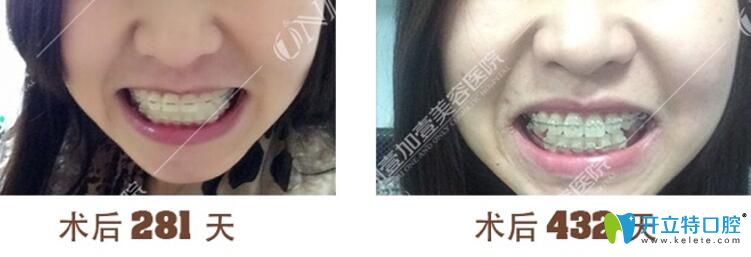 閨蜜在廣州壹加壹口腔做陶瓷托槽矯正中照片