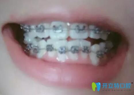 我的齙牙在團(tuán)圓口腔做金屬矯正第3個月