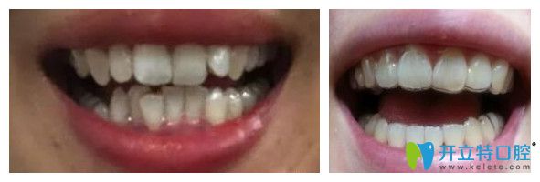 牙齒不齊達(dá)芬奇隱形矯正1到12個月效果