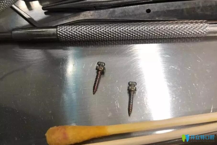 齙牙矯正中使用到的支抗釘