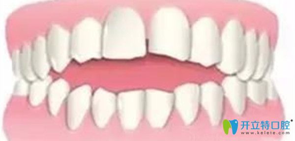 引發(fā)牙齒開合的原因及治療方法