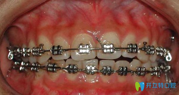 引發(fā)的牙齒開合的因素