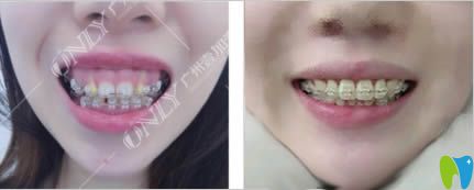 廣州壹加壹口腔做露齦笑矯正前后對比圖