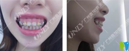 解決露齦笑尷尬，我選擇廣州壹加壹口腔做矯正