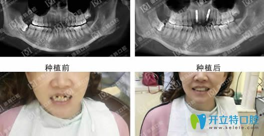 德韓口腔種植牙效果前后對(duì)比圖