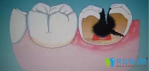 牙根部發(fā)黑是什么原因造成的