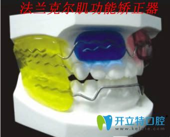 帶你了解兒童法蘭克爾肌功能矯正器的正畸原理及作用