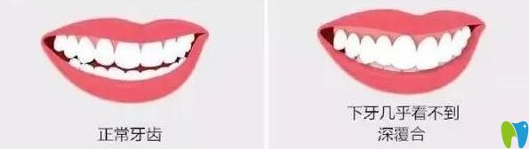 解答:上牙包住下牙多少正常？