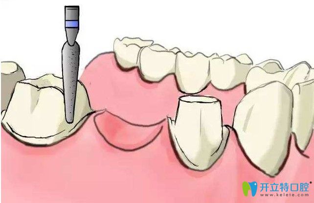 肖勇昌院長解析關(guān)于種植牙的知識(shí)