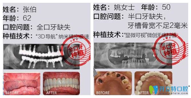 南昌德韓口腔張寧種植牙案例公布