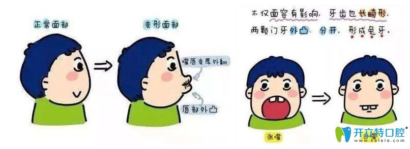 牙為什么越來越往外突，我該如何防止牙越來越外突