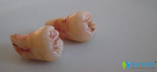 牙齒外突如何預(yù)防及治療