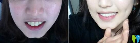 齙牙矯正前后對(duì)比圖