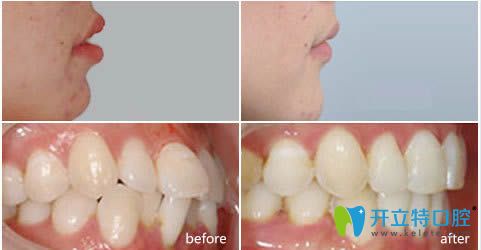 衡陽(yáng)美萊牙齒矯正效果前后對(duì)比圖