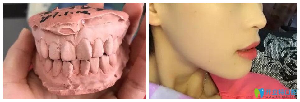 這不僅有上牙外翻圖片，還有上牙外翻矯正的方法及價(jià)格