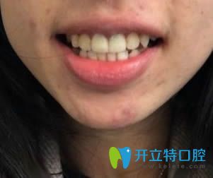 在樂山英美口腔做完二氧化鋯全瓷牙后的照片 在樂山英美口腔做完二氧化鋯全瓷牙后的照片