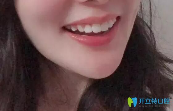 給大家看下我上牙外翻在南昌德韓口腔做矯正的效果如何