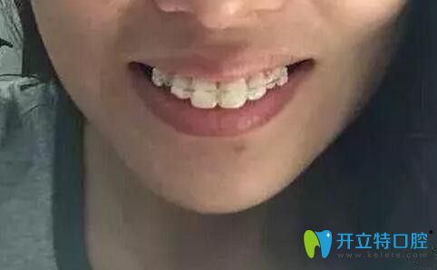 南昌德韓口腔帶金屬牙套第2天