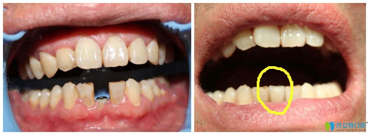 沈陽康貝佳口腔單顆牙缺失種植案例