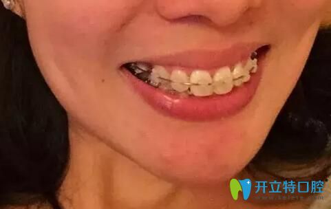 拆掉墊高的樹脂后，發(fā)現(xiàn)咬合全錯位了