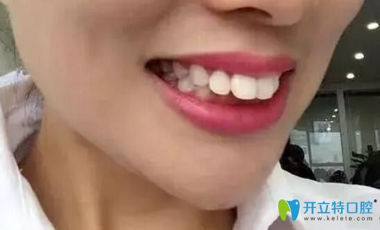 矯正前，上排門牙外凸