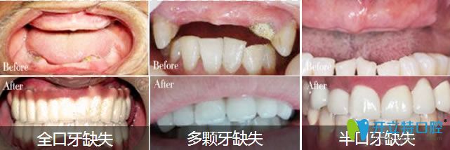 深圳弘和全口/半口種植牙對(duì)比圖